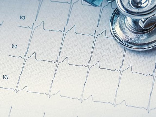 Lectura e interpretación de ECG